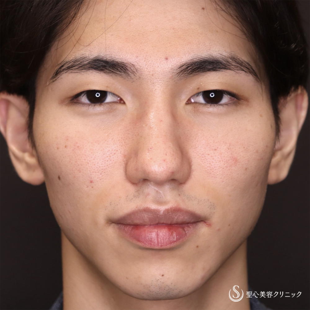 【20代男性・誰からも好かれる「格好良さ」を引き出す】マイクロメソッド+α（二重埋没法）（1週間後） Before 