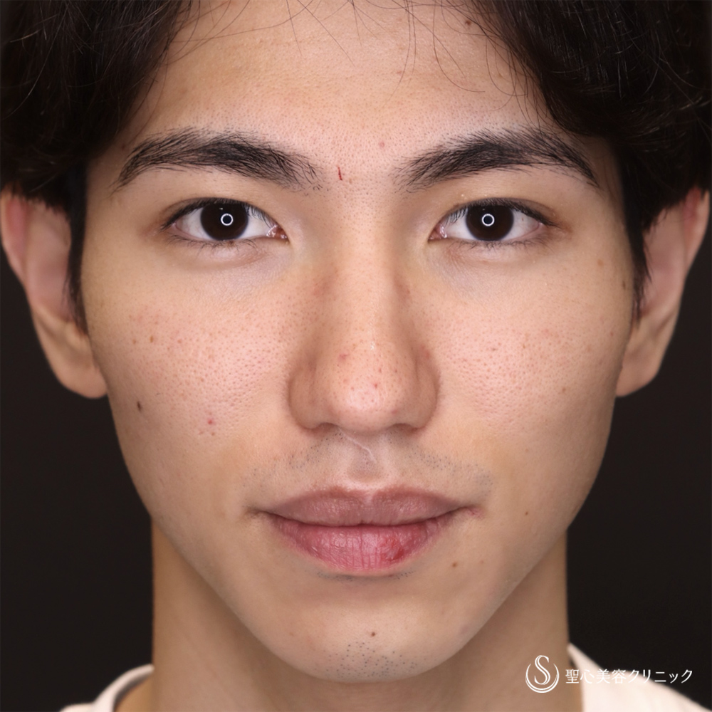 【20代男性・誰からも好かれる「格好良さ」を引き出す】マイクロメソッド+α(二重埋没法)(1週間後) After
