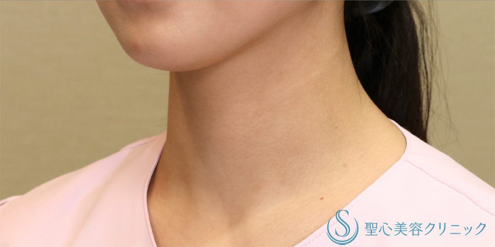 【20代女性・首の横ジワを改善】プレミアムPRP皮膚再生療法（首）（6ヶ月後） After 