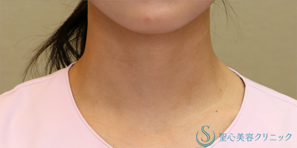 【20代女性・首の横ジワを改善】プレミアムPRP皮膚再生療法（首）（6ヶ月後） After 
