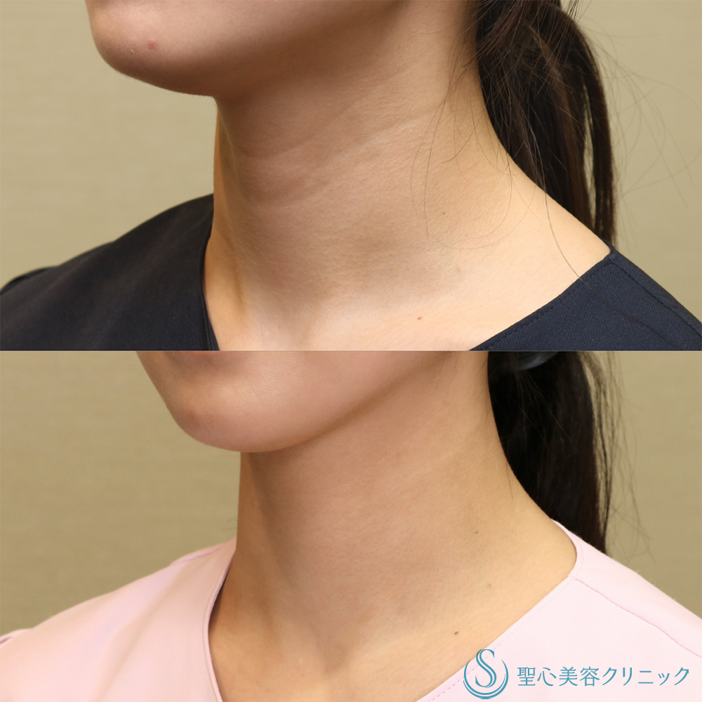 【20代女性・首の横ジワを改善】プレミアムPRP皮膚再生療法（首）（6ヶ月後） After 名古屋院