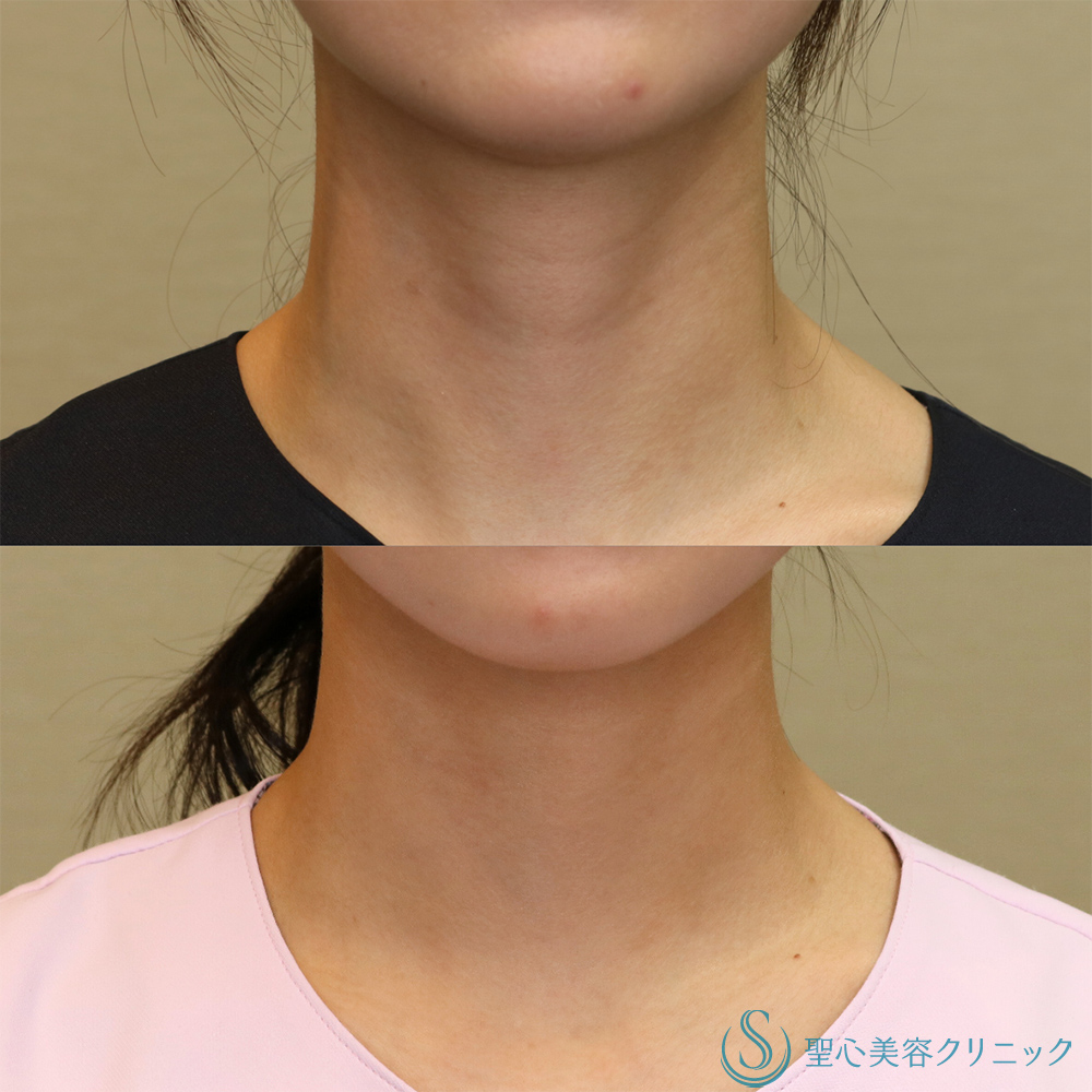 【20代女性・首の横ジワを改善】プレミアムPRP皮膚再生療法（首）（6ヶ月後） After 名古屋院