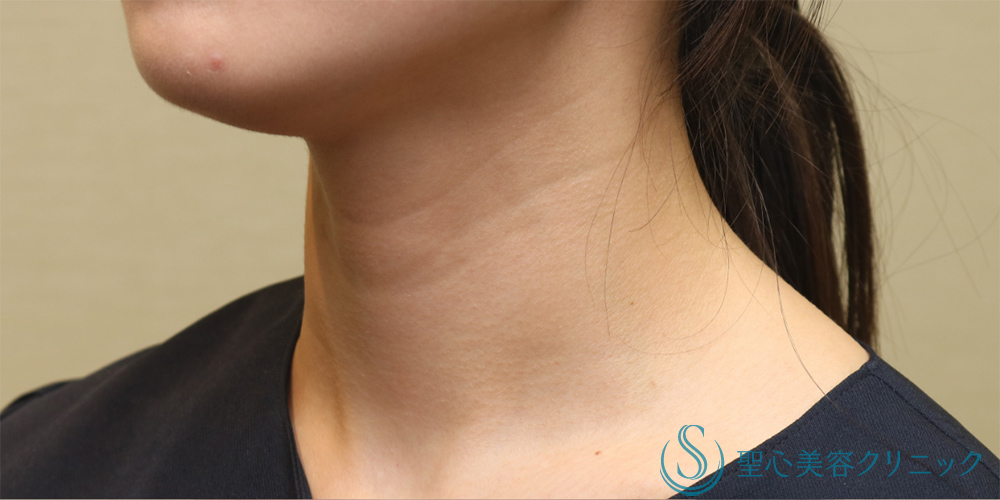 【20代女性・首の横ジワを改善】プレミアムPRP皮膚再生療法（首）（6ヶ月後） Before 