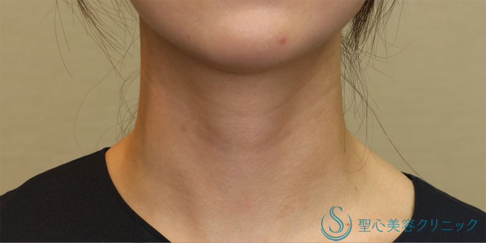 【20代女性・首の横ジワを改善】プレミアムPRP皮膚再生療法（首）（6ヶ月後） Before 