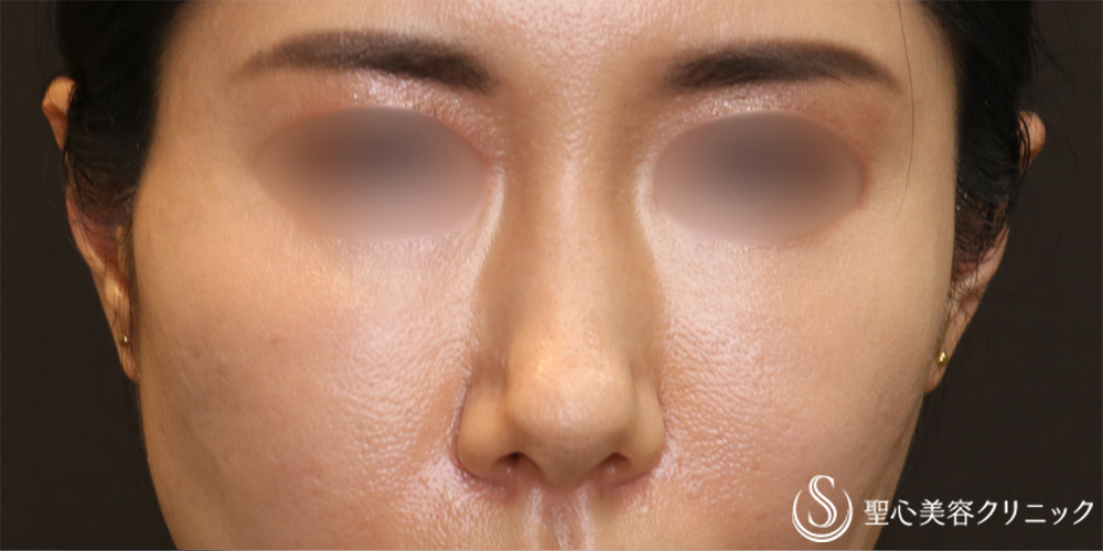【40代女性・自然な忘れ鼻に】鼻尖縮小＋鼻尖形成（耳介軟骨移植）＋G-Mesh（Gメッシュ）（6ヶ月後） Before 