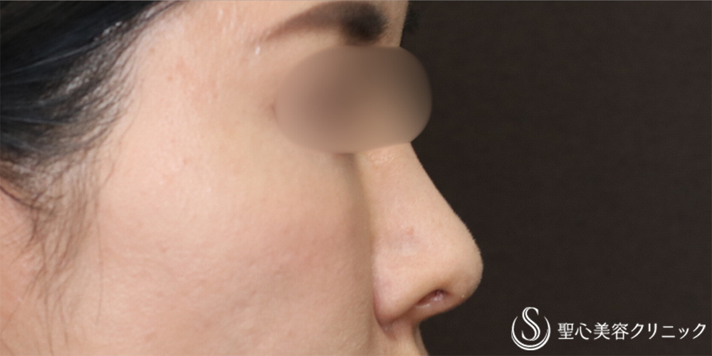 【40代女性・自然な忘れ鼻に】鼻尖縮小＋鼻尖形成（耳介軟骨移植）＋G-Mesh（Gメッシュ）（6ヶ月後） After 