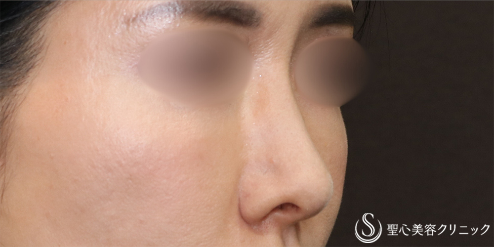 【40代女性・自然な忘れ鼻に】鼻尖縮小＋鼻尖形成（耳介軟骨移植）＋G-Mesh（Gメッシュ）（6ヶ月後） After 