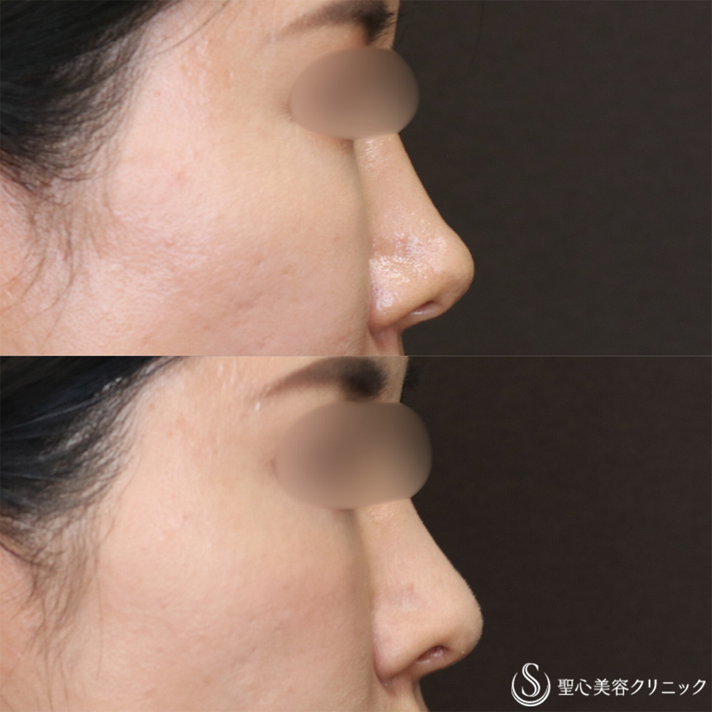 【40代女性・自然な忘れ鼻に】鼻尖縮小＋鼻尖形成（耳介軟骨移植）＋G-Mesh（Gメッシュ）（6ヶ月後） After 名古屋院・鼻整形・忘れ鼻
