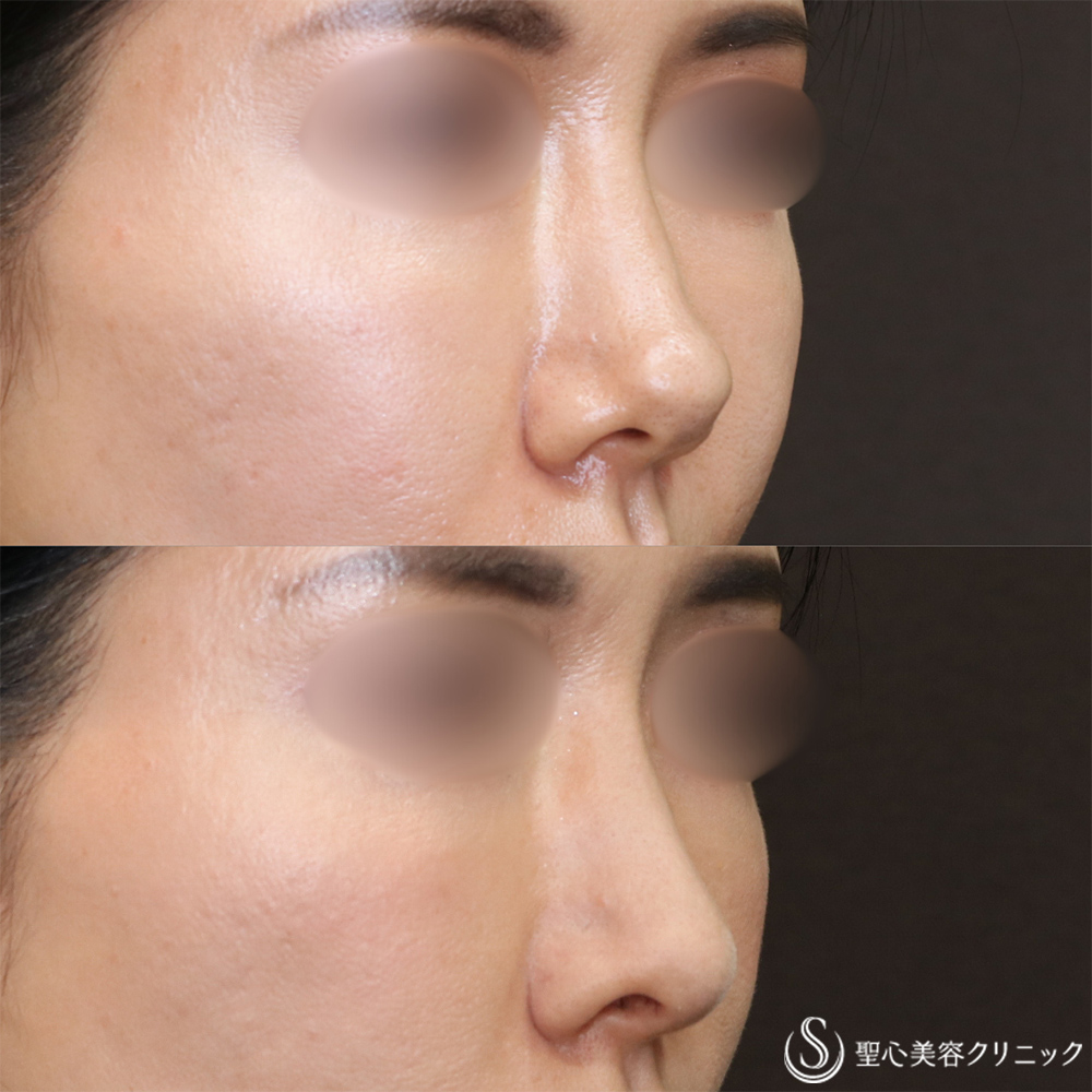 【40代女性・自然な忘れ鼻に】鼻尖縮小＋鼻尖形成（耳介軟骨移植）＋G-Mesh（Gメッシュ）（6ヶ月後） After 名古屋院・鼻整形・忘れ鼻