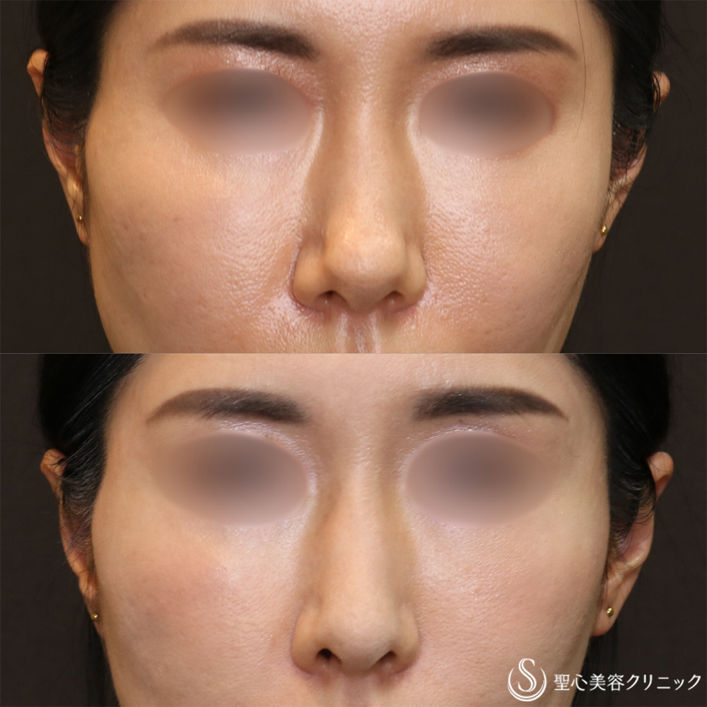 【40代女性・自然な忘れ鼻に】鼻尖縮小＋鼻尖形成（耳介軟骨移植）＋G-Mesh（Gメッシュ）（6ヶ月後） After 名古屋院・鼻整形・忘れ鼻