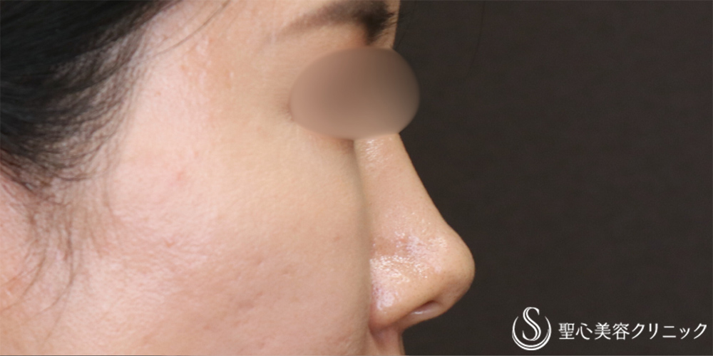 【40代女性・自然な忘れ鼻に】鼻尖縮小＋鼻尖形成（耳介軟骨移植）＋G-Mesh（Gメッシュ）（6ヶ月後） Before 