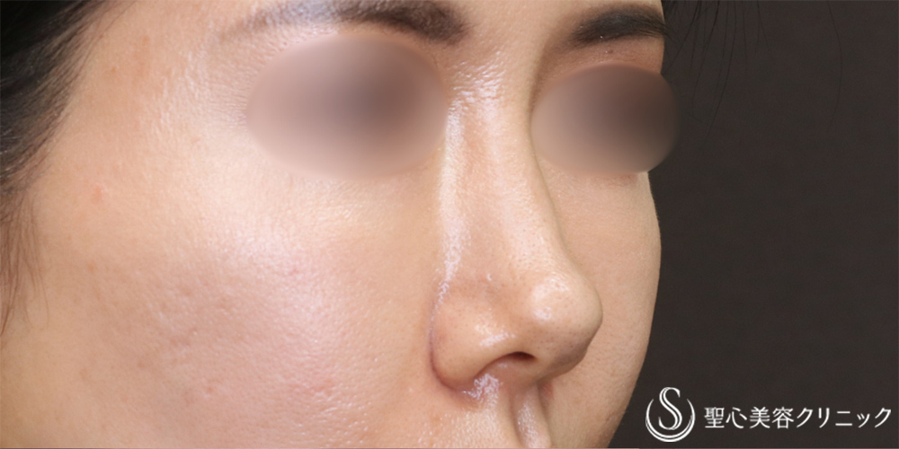 【40代女性・自然な忘れ鼻に】鼻尖縮小＋鼻尖形成（耳介軟骨移植）＋G-Mesh（Gメッシュ）（6ヶ月後） Before 