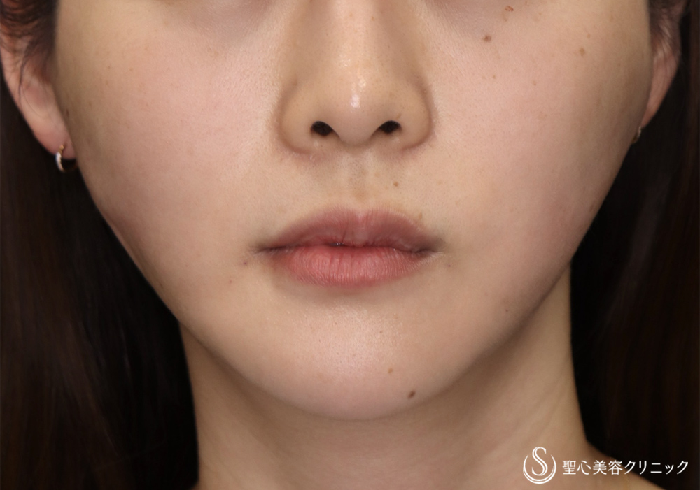 アンカーMAX_After