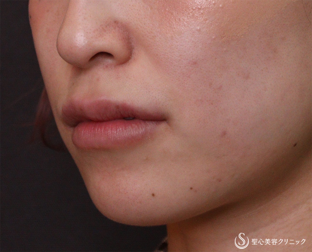 【20代女性・唇の形】ヒアルロン酸注入（唇）（レスチレンリフトリド）（2週間後） Before 