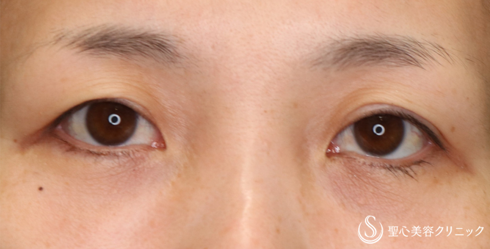 【40代女性・自然でぱっちり】眉下切開法（眉下リフト）（8ヶ月後） Before 
