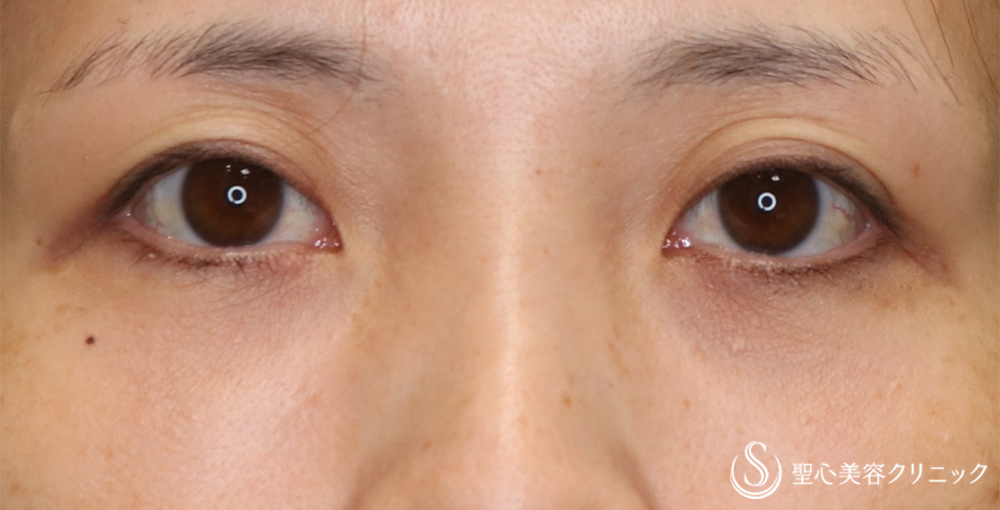 【40代女性・自然でぱっちり】眉下切開法（眉下リフト）（8ヶ月後） After 