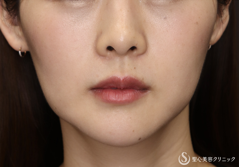 アンカーMAX_Before