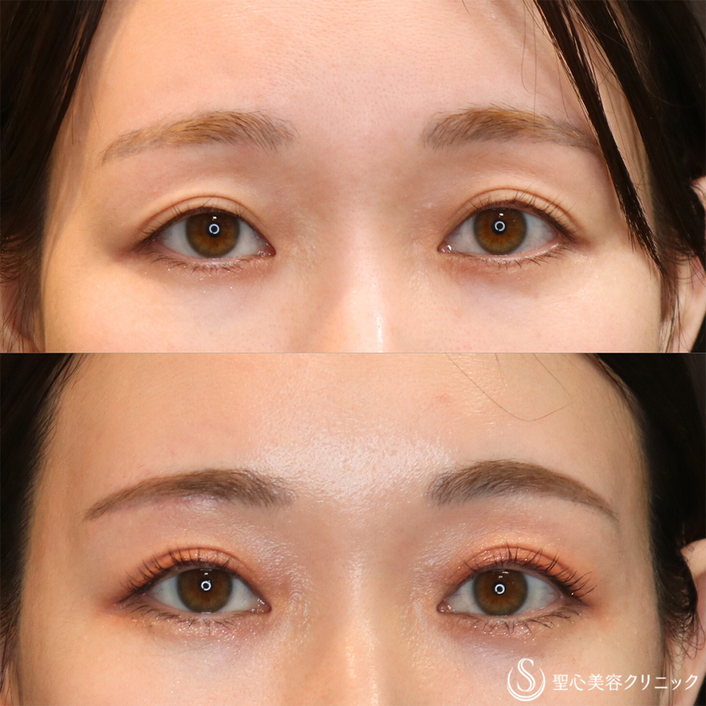 【30代女性・目の開きと左右差の改善】眉下切開法（眉下リフト）(右目のみ）（1ヶ月後） After 名古屋院・眉下リフト・目の左右差改善