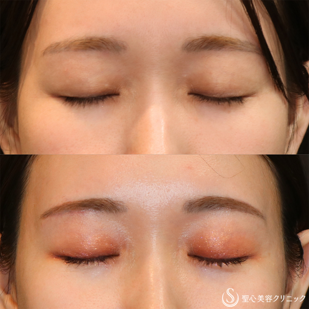 【30代女性・目の開きと左右差の改善】眉下切開法（眉下リフト）(右目のみ）（1ヶ月後） After 名古屋院・眉下リフト・目の左右差改善