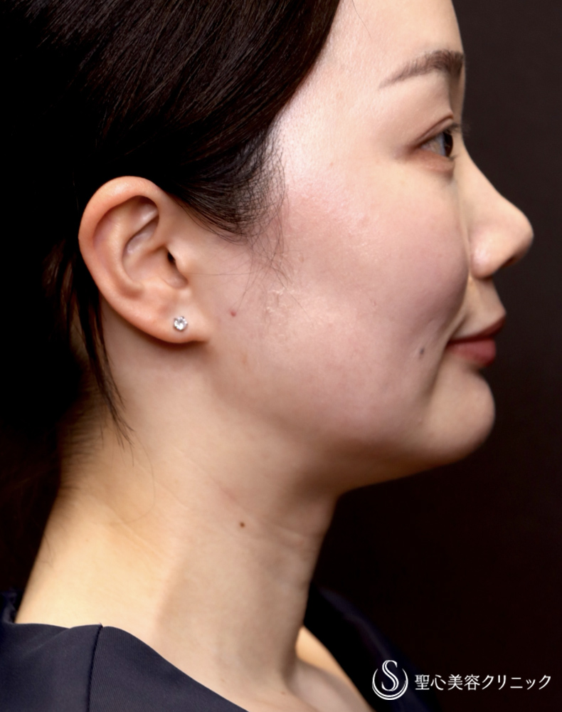 【30代女性・首元すっきりで横顔美人へ】ボトックスリフト（1ヶ月後） Before 