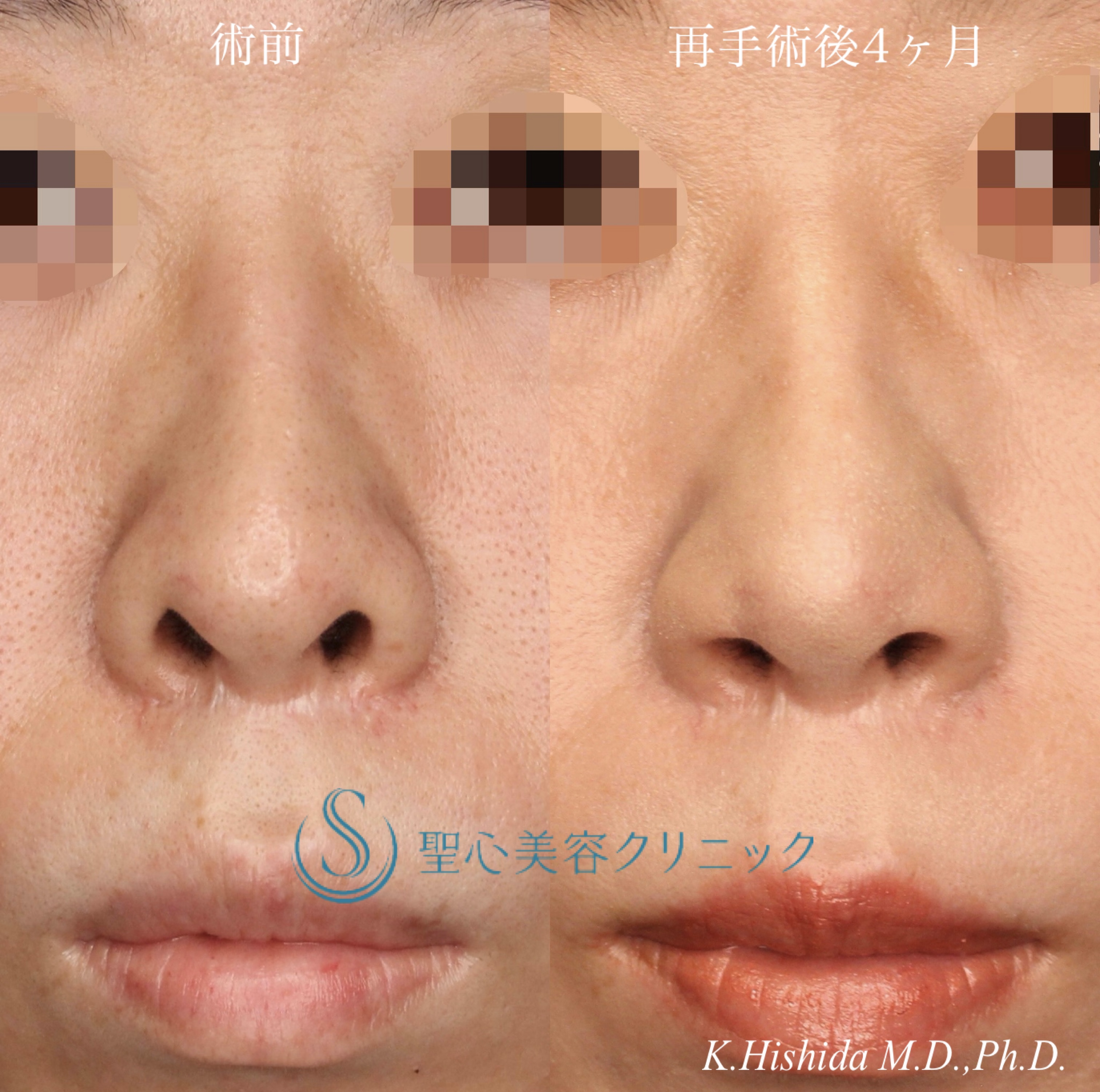 【30代女性・鼻の穴を目立ちにくくしたい】鼻孔縁下降術（再手術後4ヶ月） After 
