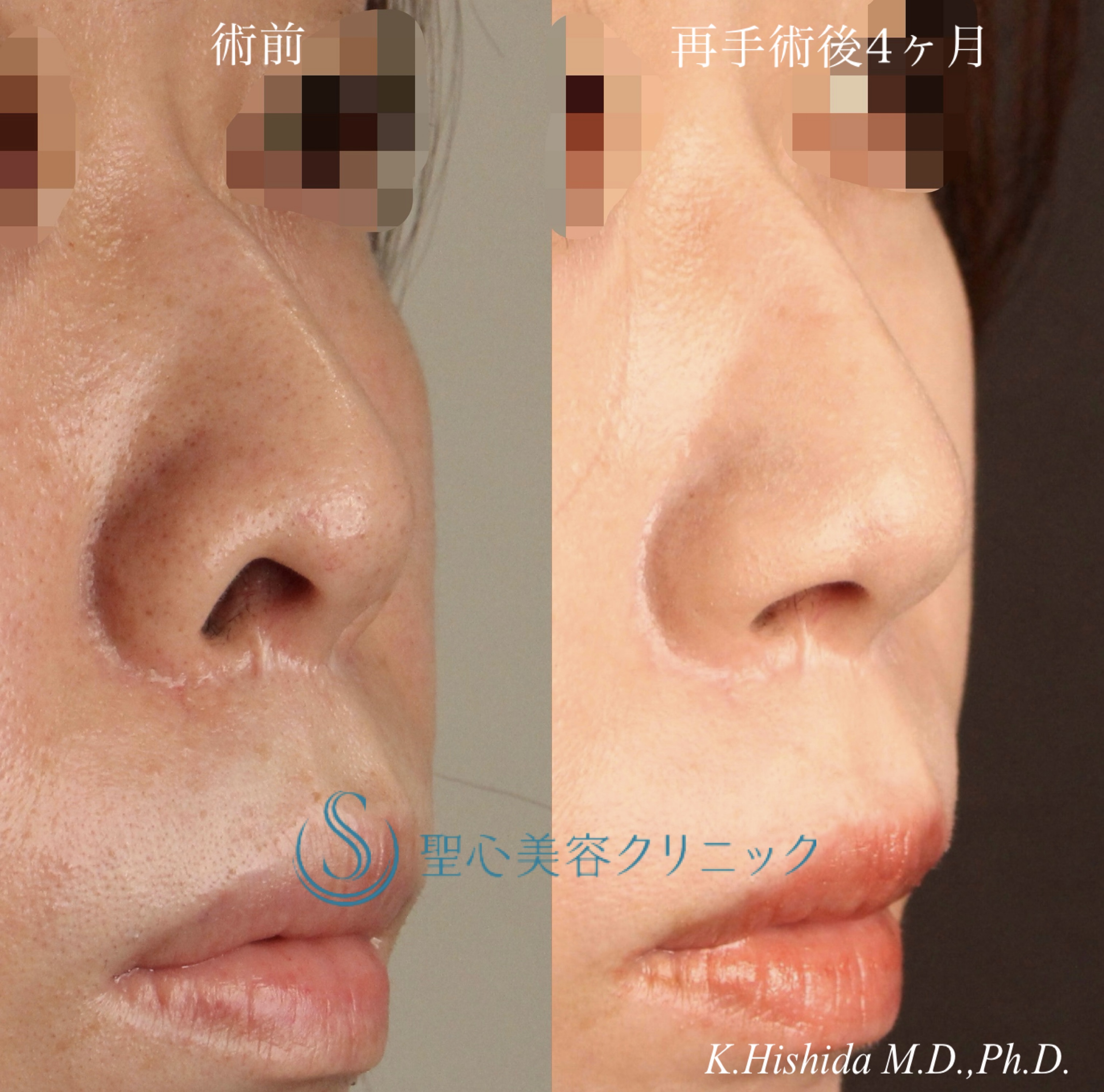 【30代女性・鼻の穴を目立ちにくくしたい】鼻孔縁下降術（再手術後4ヶ月） After 