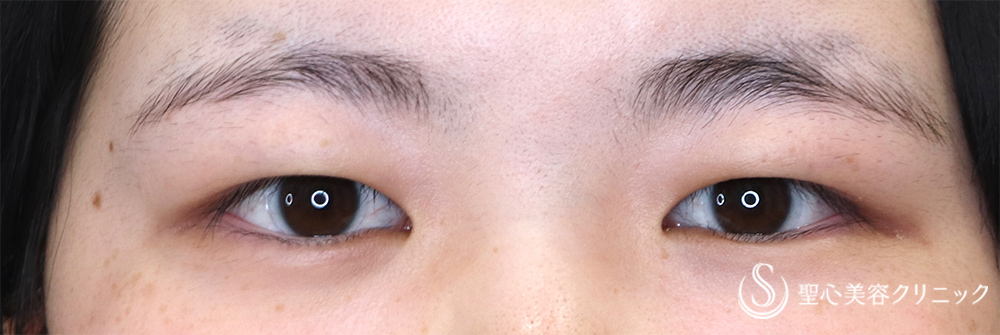 【10代女性・すっきりした目元に】二重術（切開法）＋脱脂（1ヶ月後） Before 