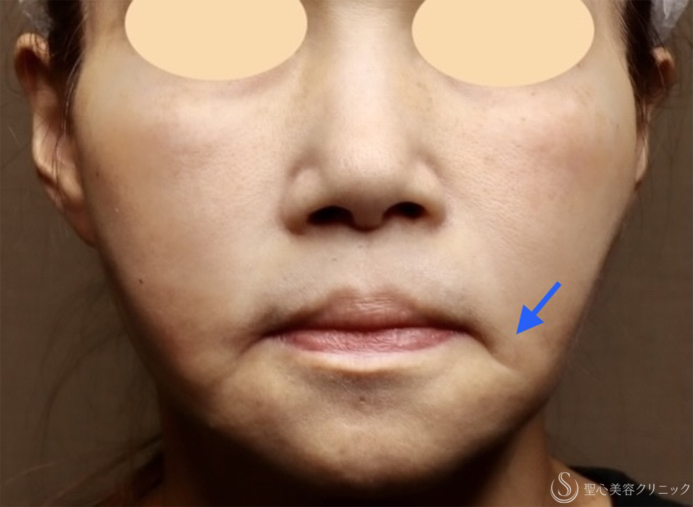 【50代女性・顔の弛み】エクステンデッドディーププレーンフェイスリフト（術後直後～術後3ヶ月） Before 