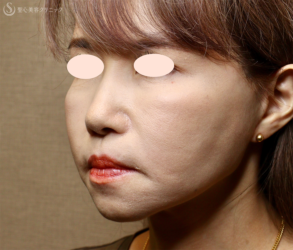 【50代女性・顔の弛み】エクステンデッドディーププレーンフェイスリフト（術後直後～術後3ヶ月） After 