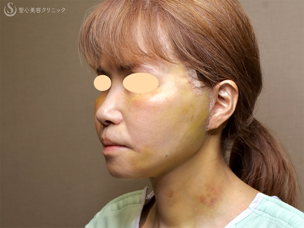 【50代女性・顔の弛み】エクステンデッドディーププレーンフェイスリフト（術後直後～術後3ヶ月） After 