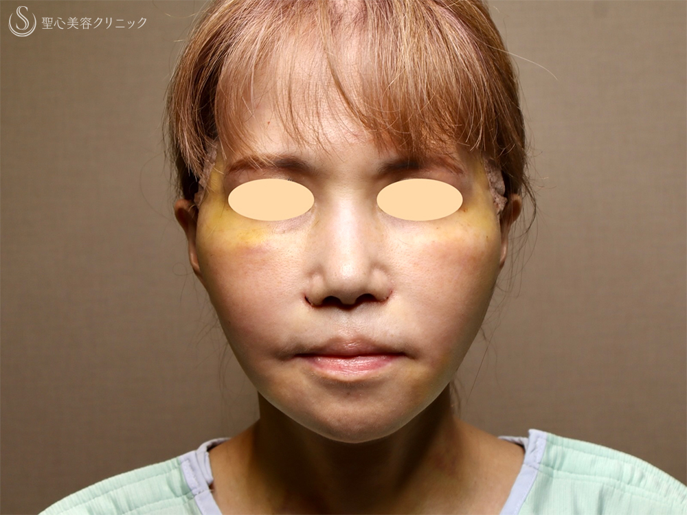 【50代女性・顔の弛み】エクステンデッドディーププレーンフェイスリフト（術後直後～術後3ヶ月） After 