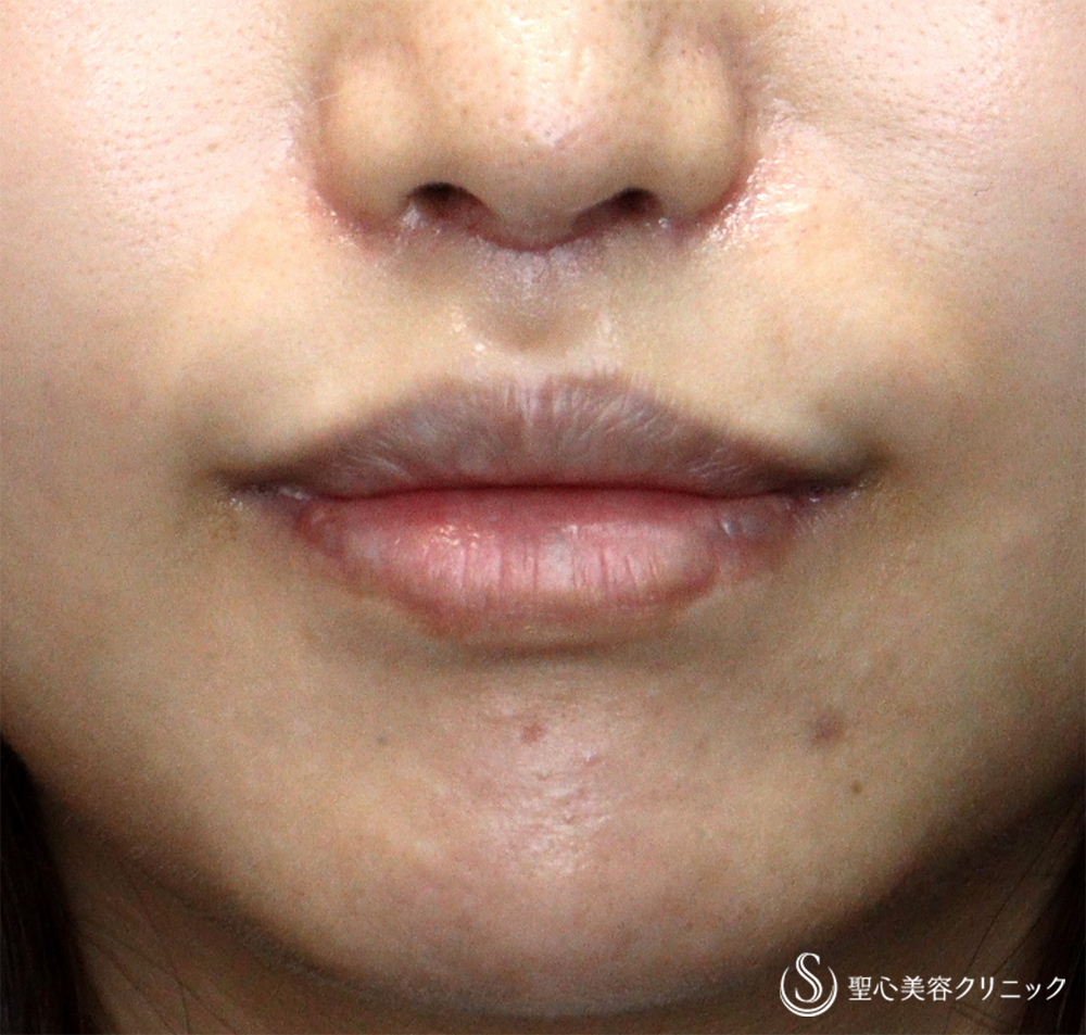 【30代女性・口周りの印象をスッキリ】　鼻下短縮術（リップリフト/人中短縮）（1ヶ月後）　 After 