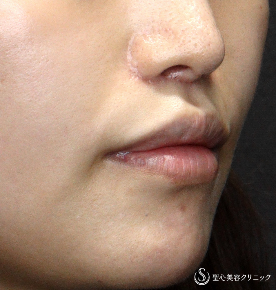 【30代女性・口周りの印象をスッキリ】　鼻下短縮術（リップリフト/人中短縮）（1ヶ月後）　 After 