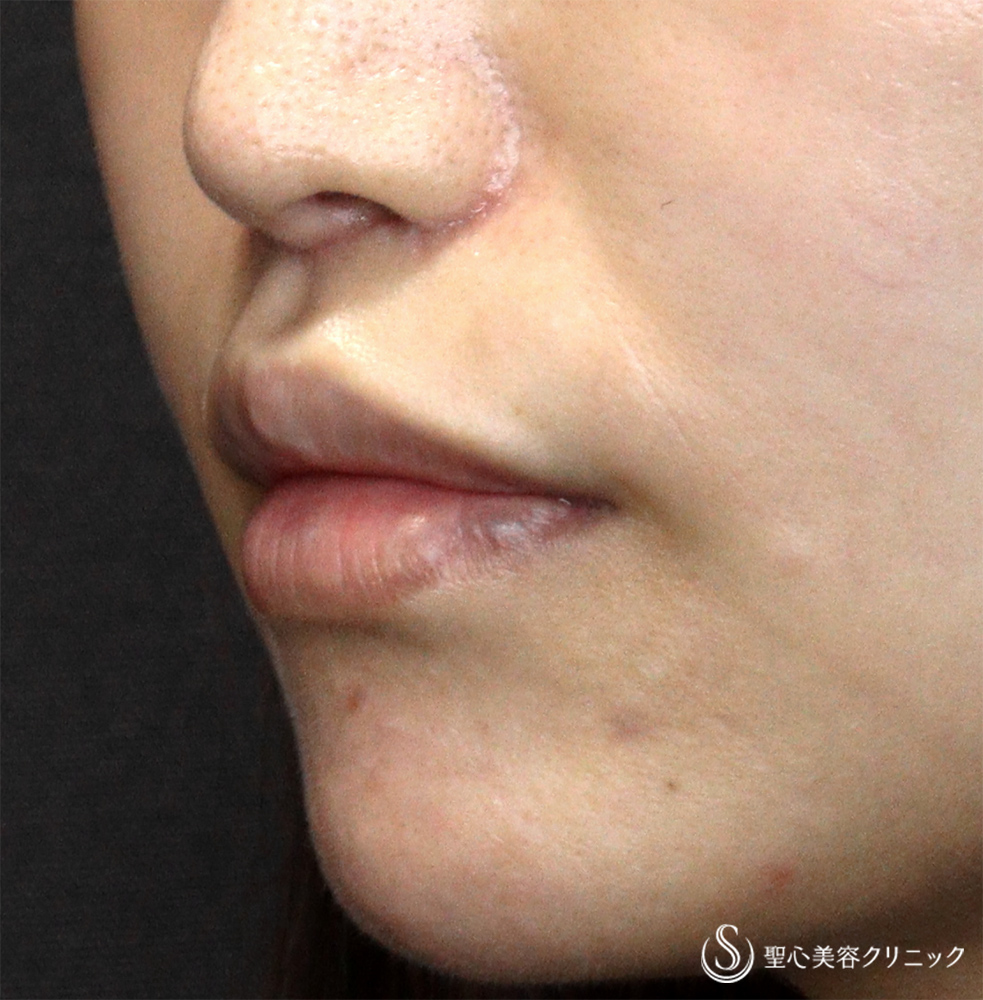 【30代女性・口周りの印象をスッキリ】　鼻下短縮術（リップリフト/人中短縮）（1ヶ月後）　 After 