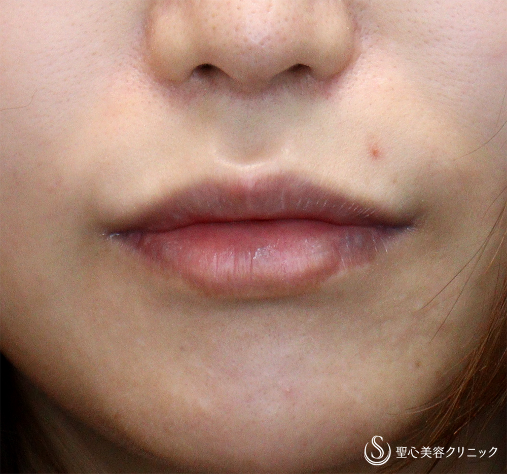 【30代女性・口周りの印象をスッキリ】　鼻下短縮術（リップリフト/人中短縮）（1ヶ月後）　 Before 