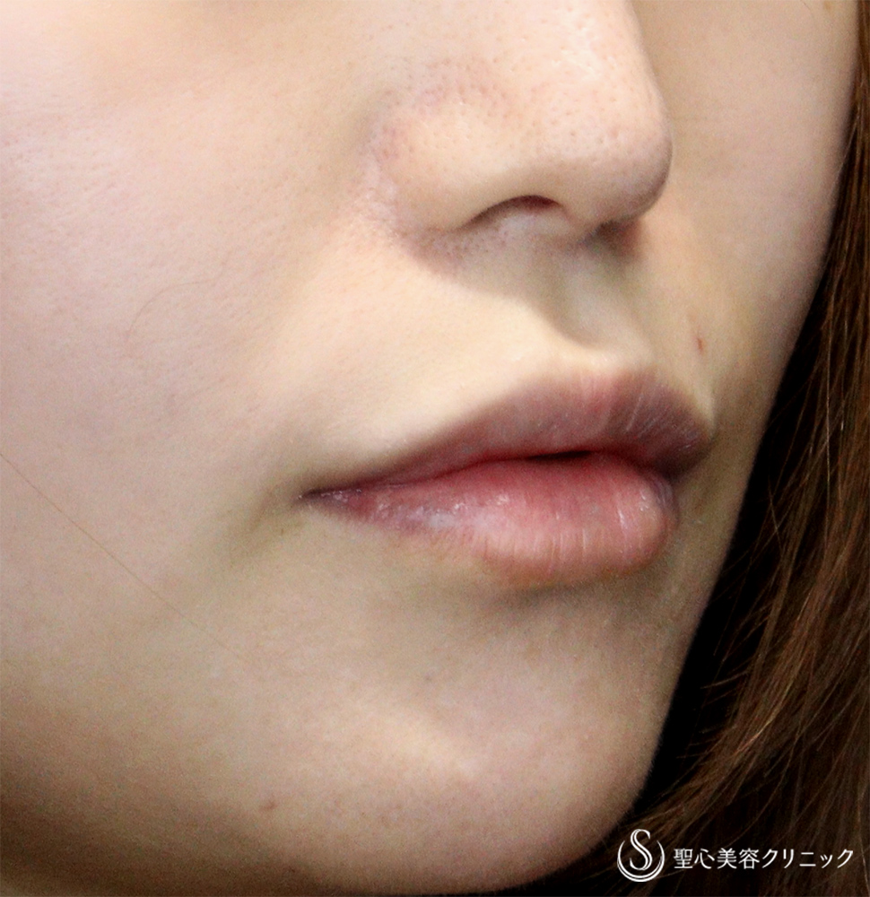 【30代女性・口周りの印象をスッキリ】　鼻下短縮術（リップリフト/人中短縮）（1ヶ月後）　 Before 