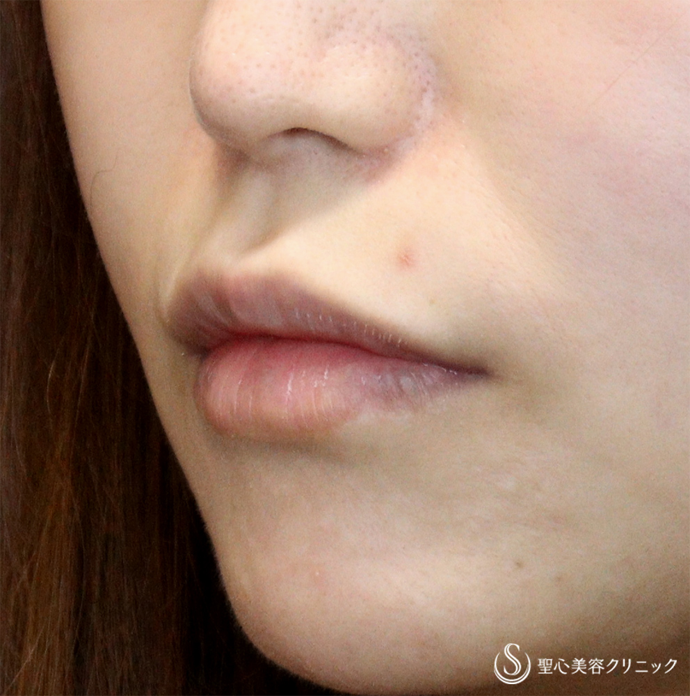 【30代女性・口周りの印象をスッキリ】　鼻下短縮術（リップリフト/人中短縮）（1ヶ月後）　 Before 