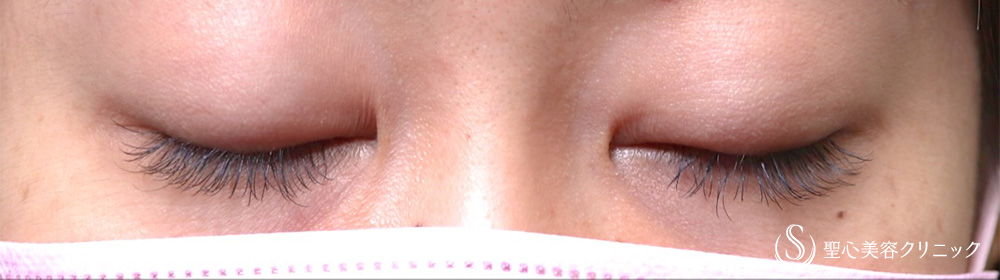 【30代女性・窪み目でも埋没法で改善】マイクロメソッド＋α（二重埋没法）（3年後） Before 