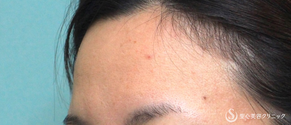 【40代女性・額の若返り】プレミアムPRP皮膚再生療法（7年後） Before 