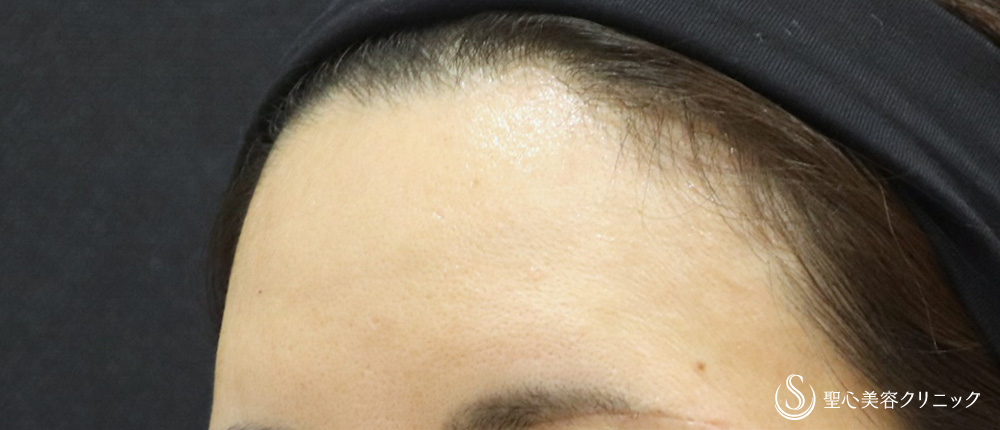 【40代女性・額の若返り】プレミアムPRP皮膚再生療法（7年後） After 