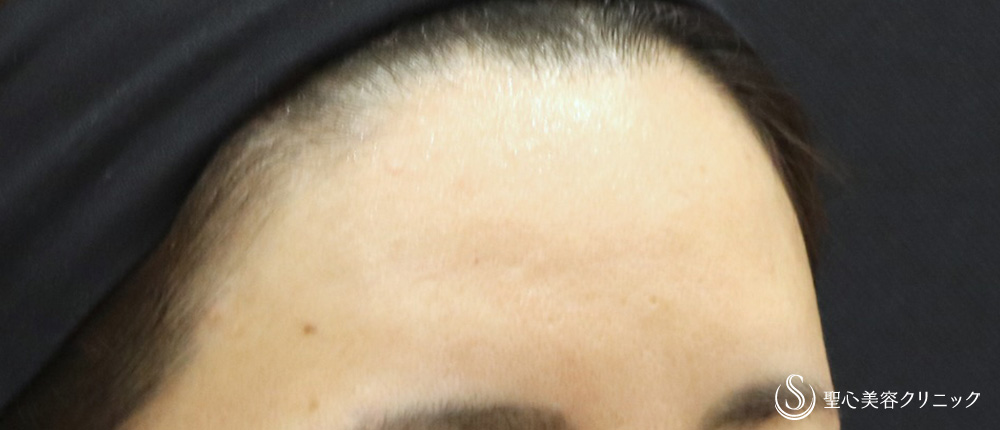 【40代女性・額の若返り】プレミアムPRP皮膚再生療法（7年後） After 