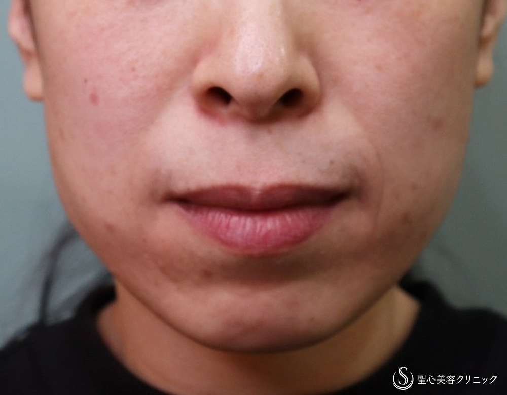 【40代女性・ほうれい線を改善】プレミアムPRP皮膚再生療法（4年後） Before 