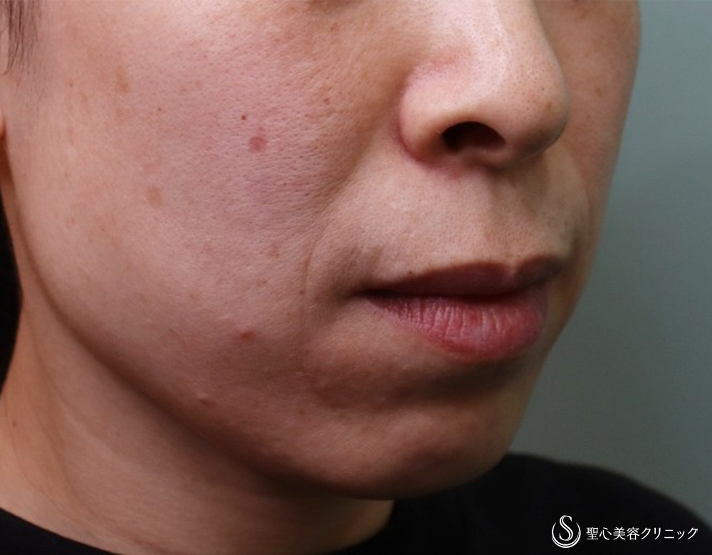 【40代女性・ほうれい線を改善】プレミアムPRP皮膚再生療法（4年後） Before 