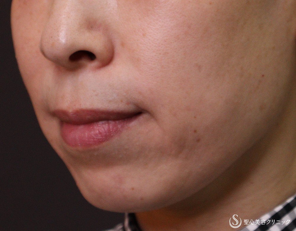 【40代女性・ほうれい線を改善】プレミアムPRP皮膚再生療法（4年後） After 