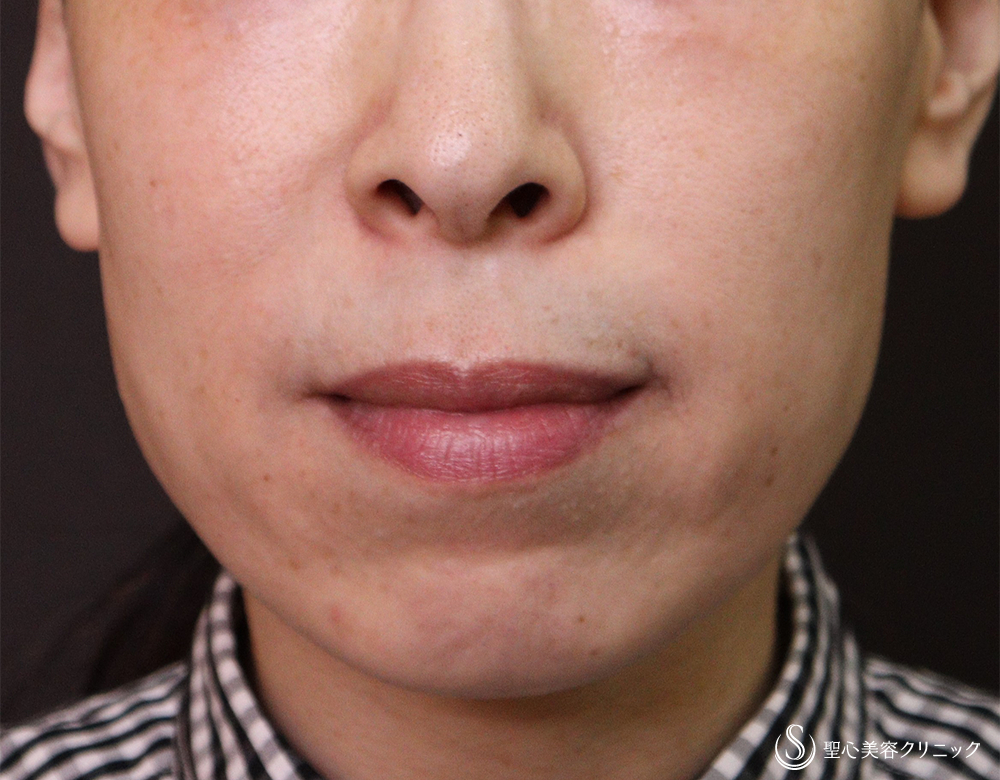 【40代女性・ほうれい線を改善】プレミアムPRP皮膚再生療法（4年後） After 