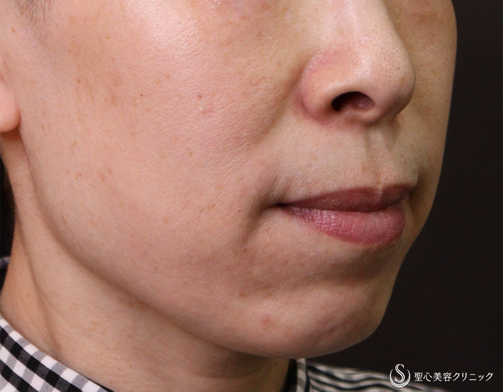 【40代女性・ほうれい線を改善】プレミアムPRP皮膚再生療法（4年後） After 