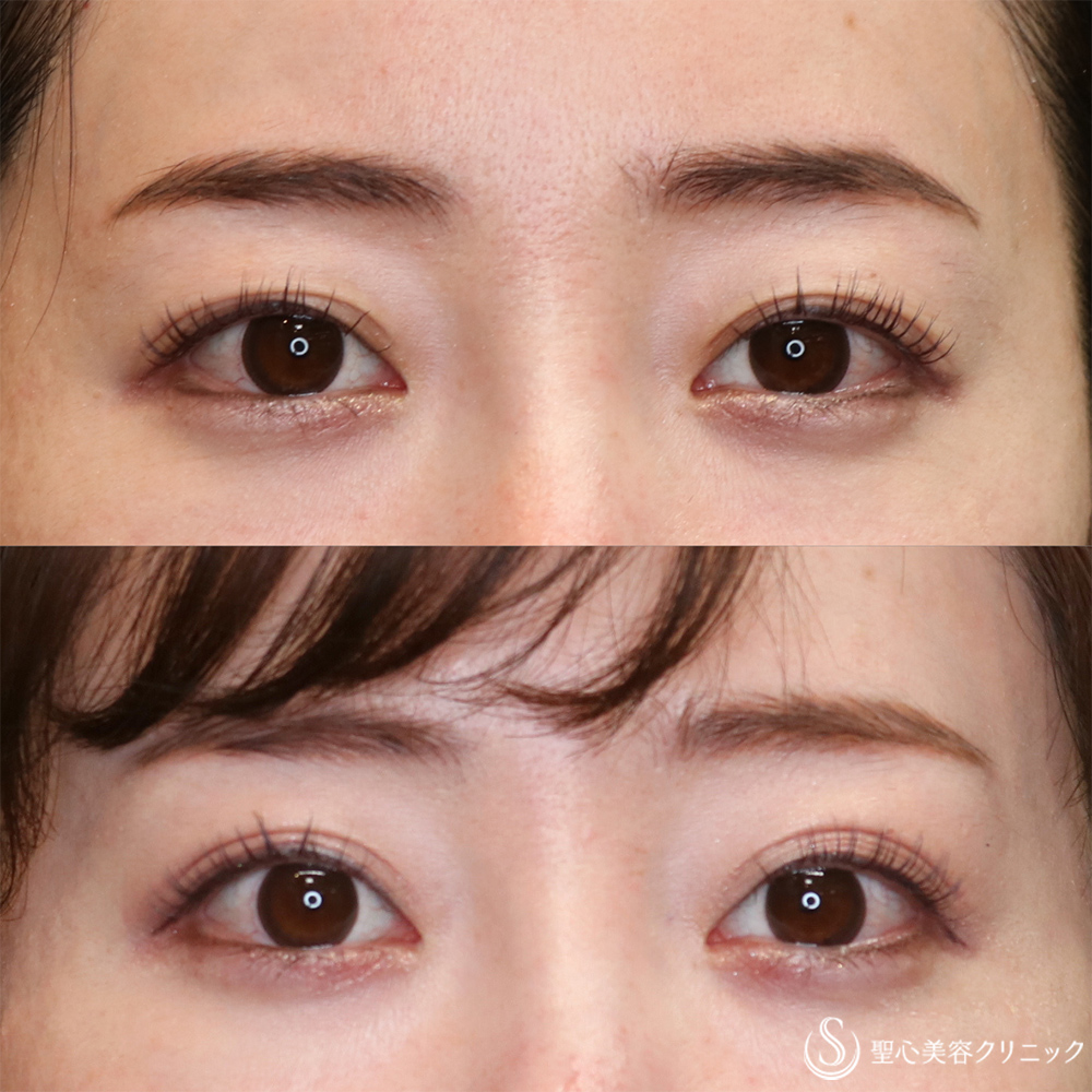 【30代女性・すっきりした平行二重に】重瞼線部分開法（目の上のたるみ取り）＋ハム目修正（1ヶ月～3ヶ月後） After 名古屋院・二重整形