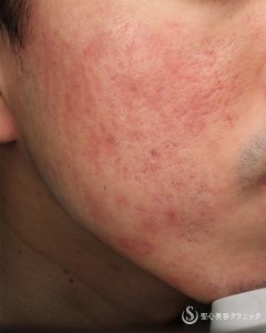 チップ　聖心夏季講習者 チップ様専用 聖心夏季講習者