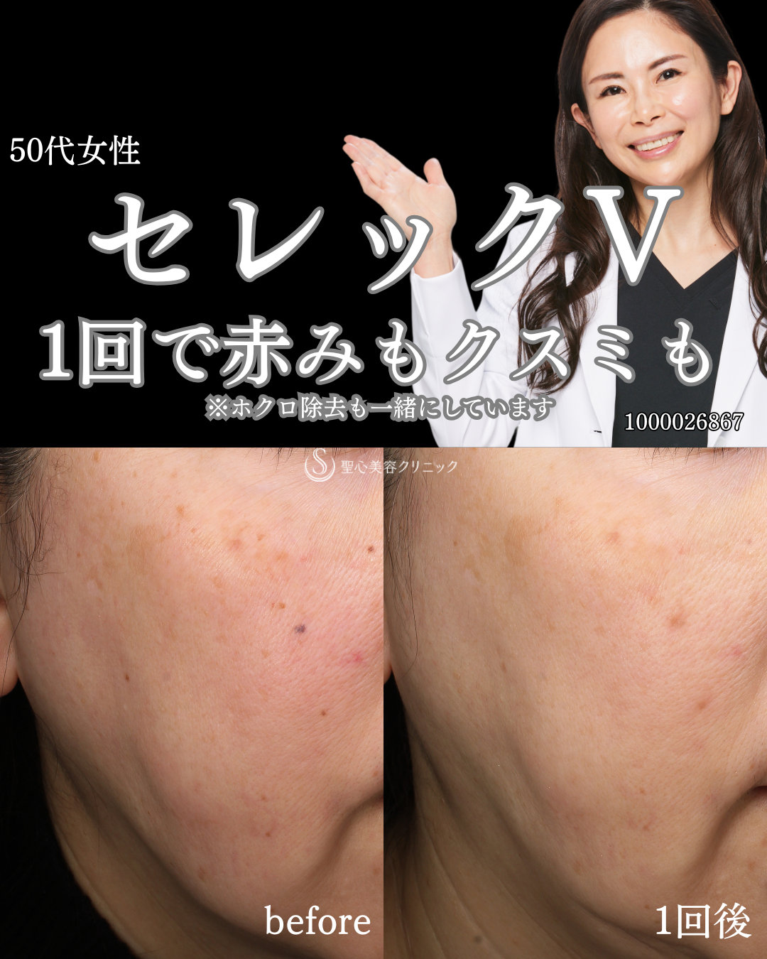 【50代女性・透明感のある肌に】CellecV（セレックV）（1ヶ月後） After 