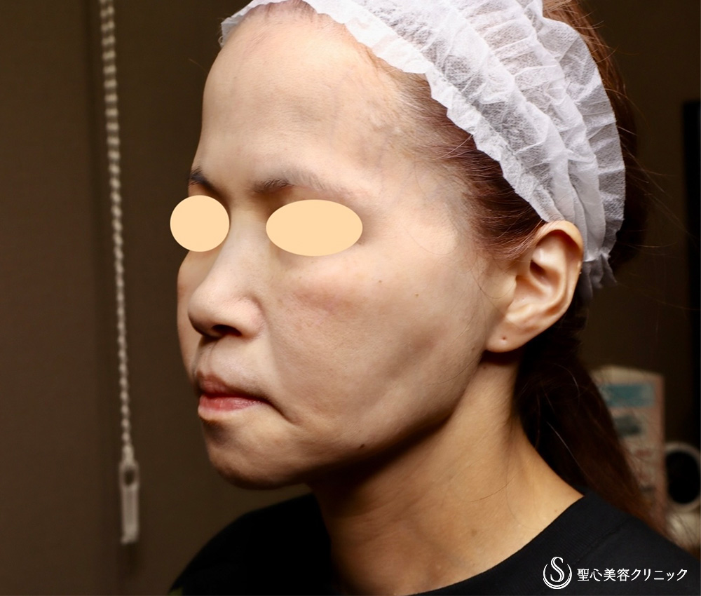 【50代女性・顔の弛み】エクステンデッドディーププレーンフェイスリフト（術後直後～術後3ヶ月） Before 